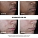 thumbnail image 4 of Tratamiento facial Neutrogena Stubborn Acne AM 75 ml con peróxido de benzoilo al 2,5%, 4 of 7