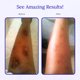thumbnail image 5 of Crema cicatricial Rejuvaskin Scar Esthetique con silicona, 10 ml, 5 of 7