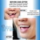 thumbnail image 3 of Kit de Dientes Instant Smile Flex Tono Natural Serie Pro, 3 of 5