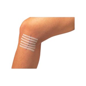 Recovery Sutura Adhesivas - Ayuda A Cerrar Cortes En La Piel