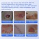 thumbnail image 5 of Wound Dressing Niceful Silver, espuma de silicona, 10 x 10 cm, paquete de 5, 5 of 6