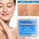 thumbnail image 1 of 30pcs/box Mole Removal Shrink Ring Non-Toxic Mole Removal Rubber Bands Kit Wart Treat Tool for Men Women Beauty Health Care, 1 of 3