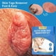 thumbnail image 3 of 2 In1 Painless Auto Skin Tag Mole Removal Kit Cleaning Tools Face Skin Care Body Dot Treatments Remover Beauty Health, 3 of 3