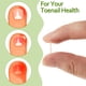 thumbnail image 4 of Tiras correctoras para uñas encarnadas (50/100 unidades), parches correctores para uñas curvadas, pinzas para enderezar y recuperar uñas encarnadas, para hombres y mujeres, cuidado de los pies., 4 of 6