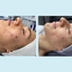 thumbnail image 5 of Gel salicílico Chemical Peel Perfect Image 20% con té verde, 5 of 9