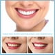thumbnail image 3 of Ormromra 1 par de prótesis dentales cosméticas, carillas instantáneas, prótesis dentales temporales, dentaduras postizas superiores e inferiores, carillas dentales cosméticas, prótesis dentales rápida, 3 of 5