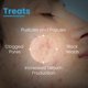 thumbnail image 5 of Limpiador Facial FIXDERMA COSMETIC 100 ml 2 % Peróxido de Benzoilo, 5 of 7