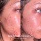thumbnail image 4 of Dispositivo de Terapia de Luz Solawave Bye Acne con LED Azul y Rojo, 4 of 9