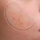 thumbnail image 2 of Set 2 Parches Para Acne Microagujas Imperfecciones Piel Lau, 2 of 3