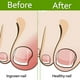 thumbnail image 5 of Tiras correctoras para uñas encarnadas (50/100 unidades), parches correctores para uñas curvadas, pinzas para enderezar y recuperar uñas encarnadas, para hombres y mujeres, cuidado de los pies., 5 of 6