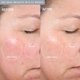 thumbnail image 4 of Microderm PMD Beauty Elite Pro London Fog + Suero, 4 of 9
