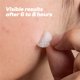 thumbnail image 3 of Parche de Acné HANHOO 108 uds – Reduce espinillas y puntos blancos, 3 of 8