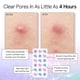 thumbnail image 3 of Parches para espinillas Pore Strip, hidrocoloide Grace & Stella, 72 unidades, 3 of 9