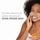 thumbnail image 3 of Jabon BARRA Neutrogena Acne 100g, 3 of 3