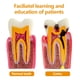 thumbnail image 3 of Dientes de caries dental modelo Ceonam 6 veces agrandados, 3 of 6