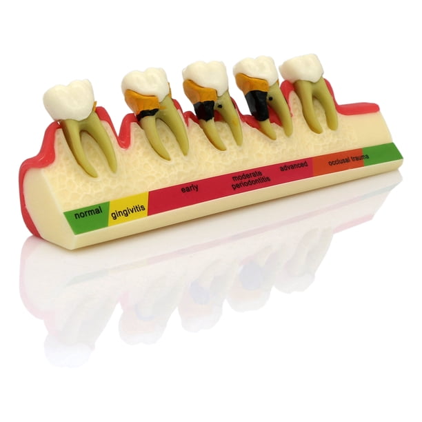 Dental Pathological Typodont Teeth Model Periodontics Implant Endodontic Caries Treatment Typodont Model Adult Children Teeth
