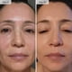 thumbnail image 5 of Sistema de Microinfusión Facial Qure para Todo Tipo de Piel - 3 Meses, 5 of 9