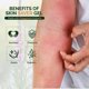thumbnail image 3 of Gel para cicatrices Moraz Skin Saver Herbal Healing, 50 ml, para el cuidado de heridas, 3 of 8