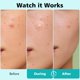 thumbnail image 3 of Parches Para Granos 600 Hydrocolloid Acne Care, 3 of 9
