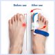thumbnail image 5 of Corrector de juanetes ERSANLI Bunion Valgus para hombres y mujeres, 5 of 6
