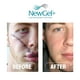 thumbnail image 3 of Gel de tratamiento de cicatrices Newgel+E Advanced Silicone 15 g con vitamina E, 3 of 3