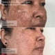 thumbnail image 3 of Tratamiento de hiperpigmentación Sente Cysteamine HSA 50 ml, 3 of 3