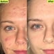 thumbnail image 3 of Kit de cuidado de la piel Acne System SLMD de Dr. Pimple Popper para 30 días y 4 piezas, 3 of 3
