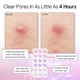 thumbnail image 3 of Pimple Patches Heart Hydrocoloid Zit 36 Unidades, 3 of 9