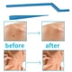 thumbnail image 3 of Get Rid of Skin Tags, Moles and Warts with 10Pcs Skin Tag Removal Kit for Adults - Includes Cleansing Swabs - Amazingly Effective!, 3 of 4