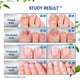 thumbnail image 5 of Tratamiento de hongos OSIMOON Extra Strength para uñas de los pies, 2 paquetes, 5 of 7