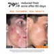 thumbnail image 4 of Sistema natural facial Norse Organics para el acné en 3 pasos, 4 of 9