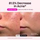 thumbnail image 4 of Máscara facial LED wavytalk de terapia con luz roja – Rosa, 4 of 9