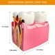 thumbnail image 2 of Dientes de caries dental modelo Ceonam 6 veces agrandados, 2 of 6